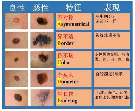 黑痣的形成|痣